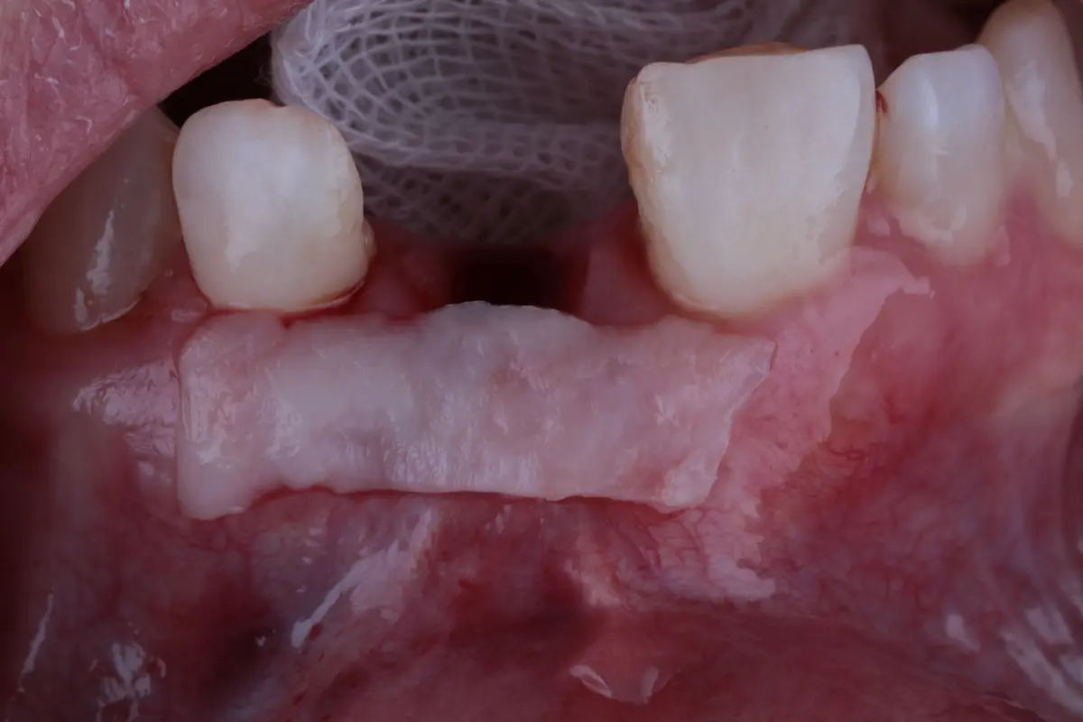 formación en regeneración ósea dental
