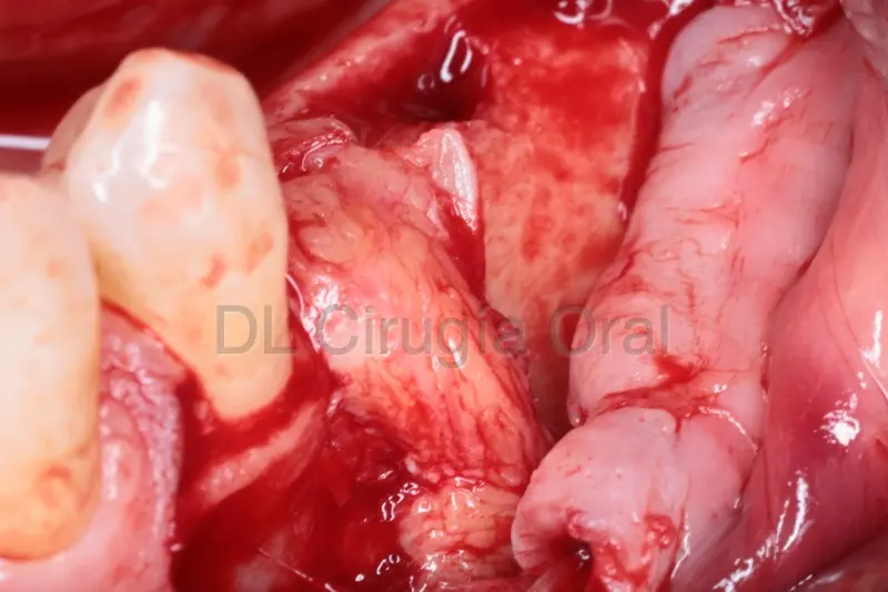 tejido blando en implantes con falta de hueso
