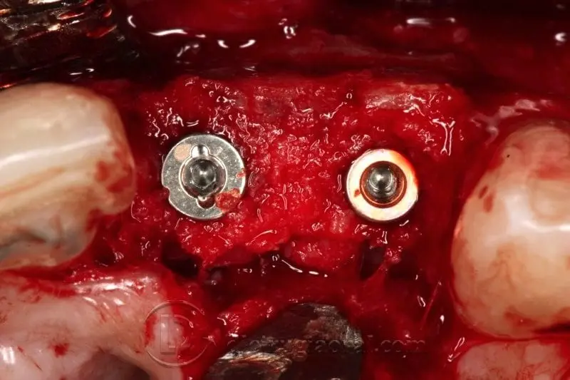 colocación nuevos implantes