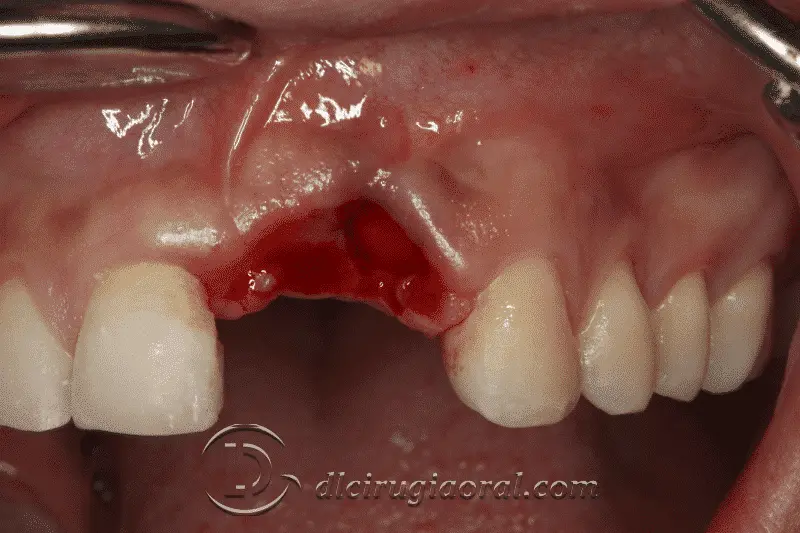 injerto-dental-fracasado