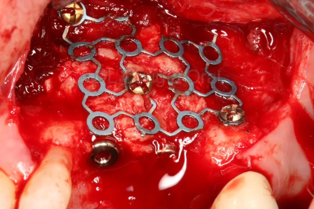 malla de titanio para estabilizar hueso autólogo en implantes