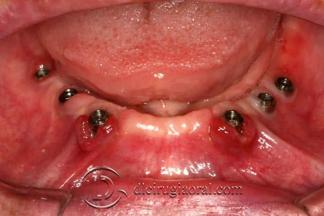 ausencia de tejido queratinizado y mucositis