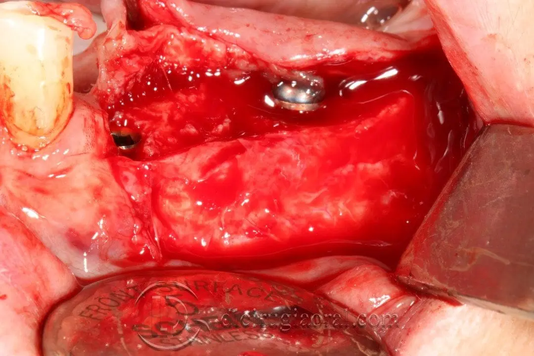vestibuloplastia e implante en la misma cirugía